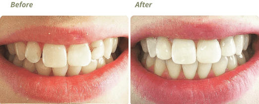 Invisalign before and after 1