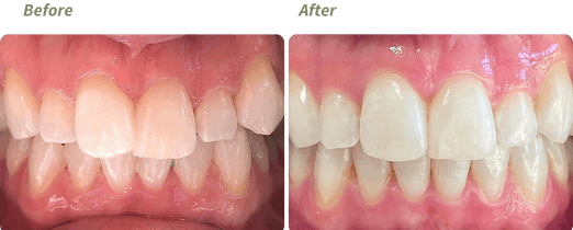 Invisalign before and after 2