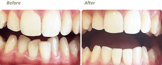 Invisalign before and after 3