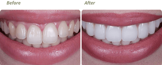 Invisalign before and after 4